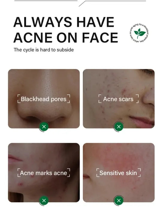 FORT Anti Acne Serum